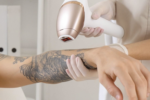 Bild von Tattoo-Entfernung